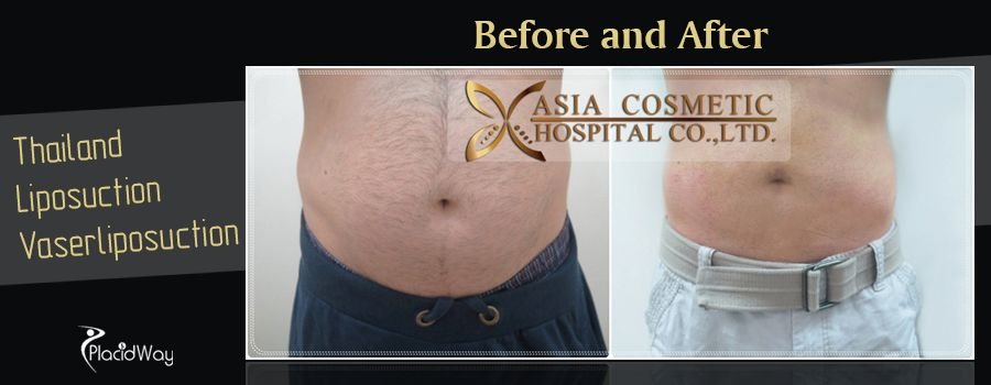 Before and After Liposuction Surgery in Thailand